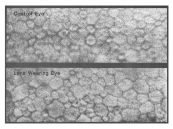 ▲Holden & Efron 연구논문에 수록된 각막 내피다형화 (그림 인용, Invest Ophthalmol Vis Sci, 1985. Fig 7)